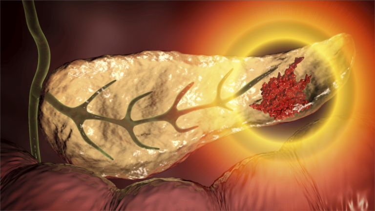 cancer_de_pancreas_blog_version_escritorio